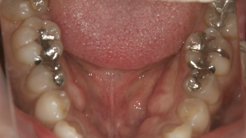 奥歯が銀歯の状態