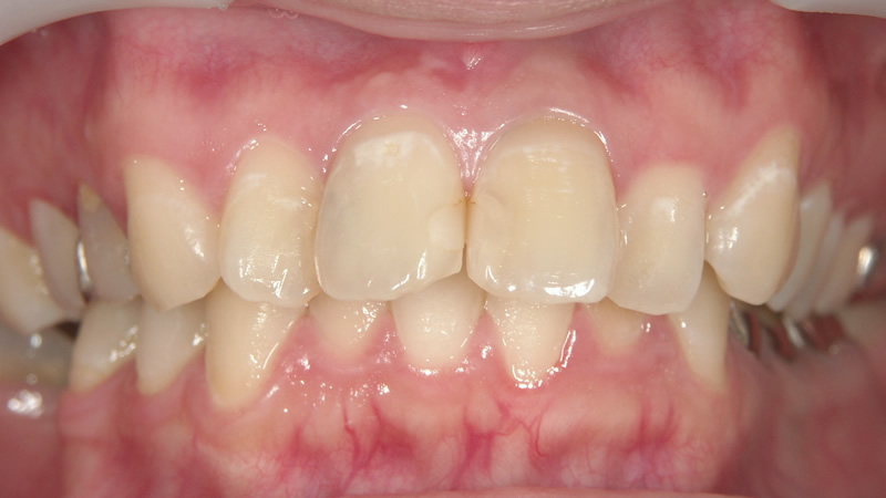 前歯4本の治療例（前）