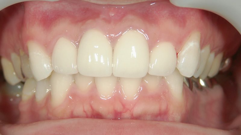 前歯4本の治療例（後）