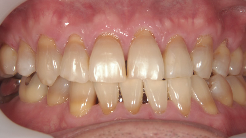 前歯6本以上の治療例（前）