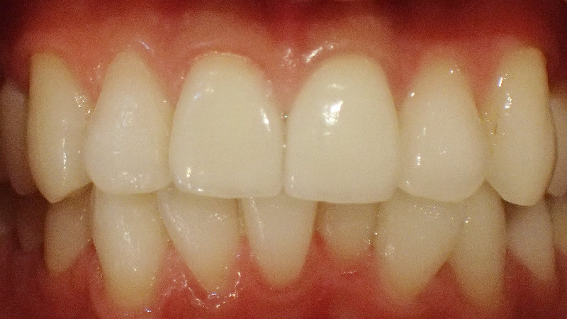 前歯2本の連結冠（連冠）を単冠で再治療後