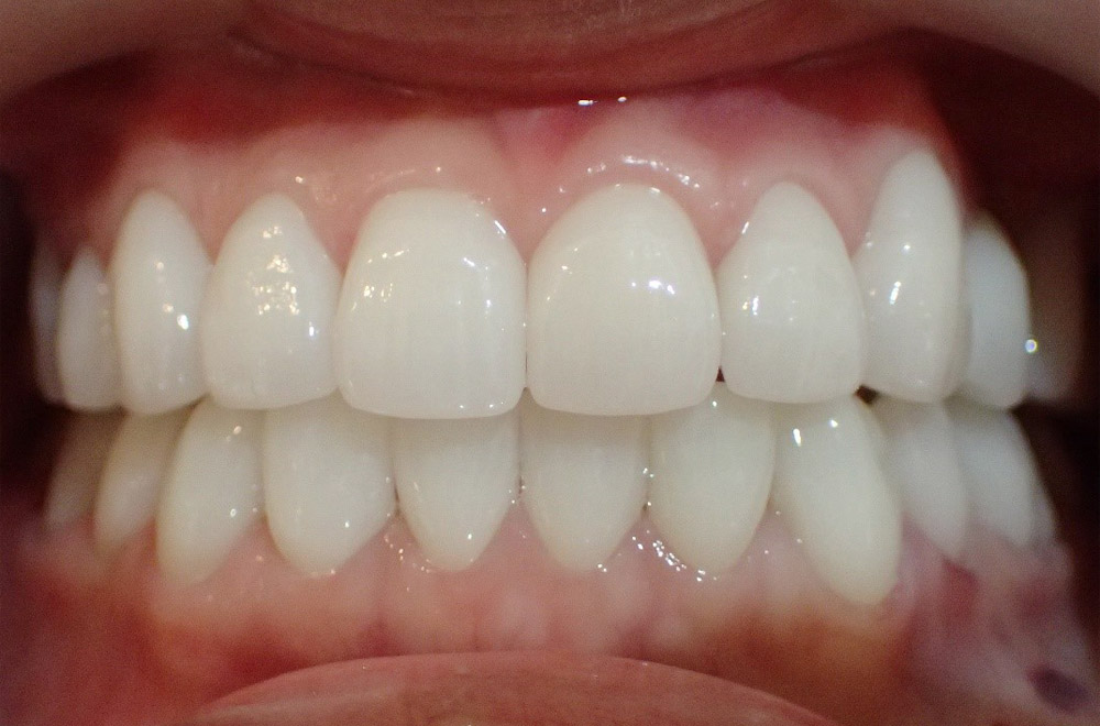 セラミックスマイルプラン治療後
