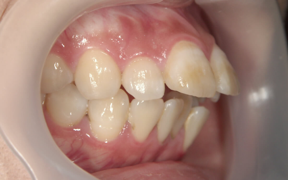 上下の歯が前に出た口ゴボケース1