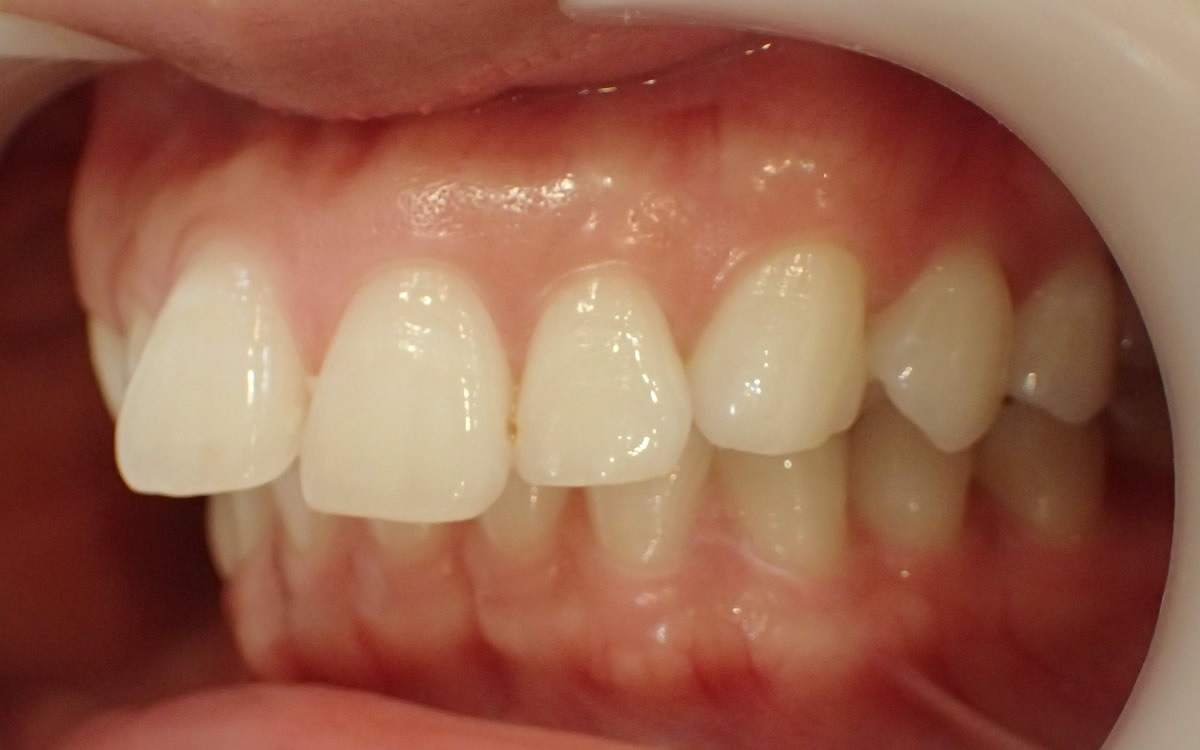 セラミック矯正で出っ歯を治療する前