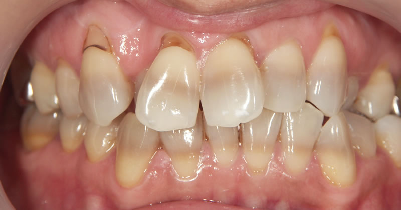 テトラサイクリン歯の例
