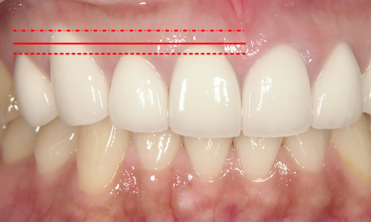 理想的な歯茎の位置。犬歯が一番高く、2番目が一番低い