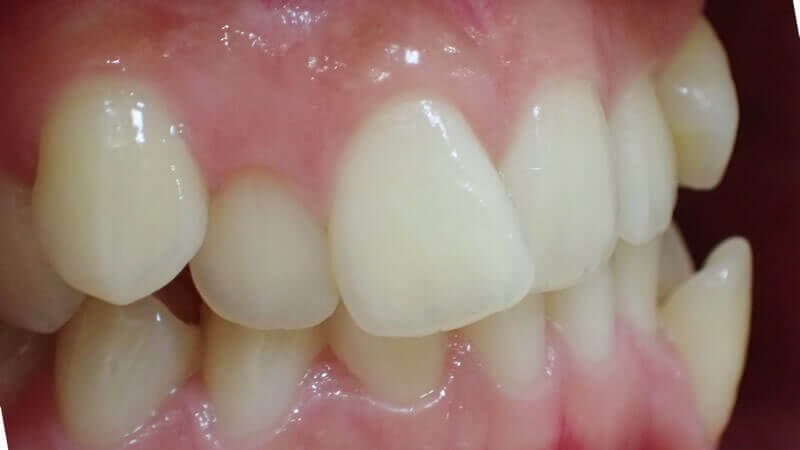 前歯の治療前（横顔）