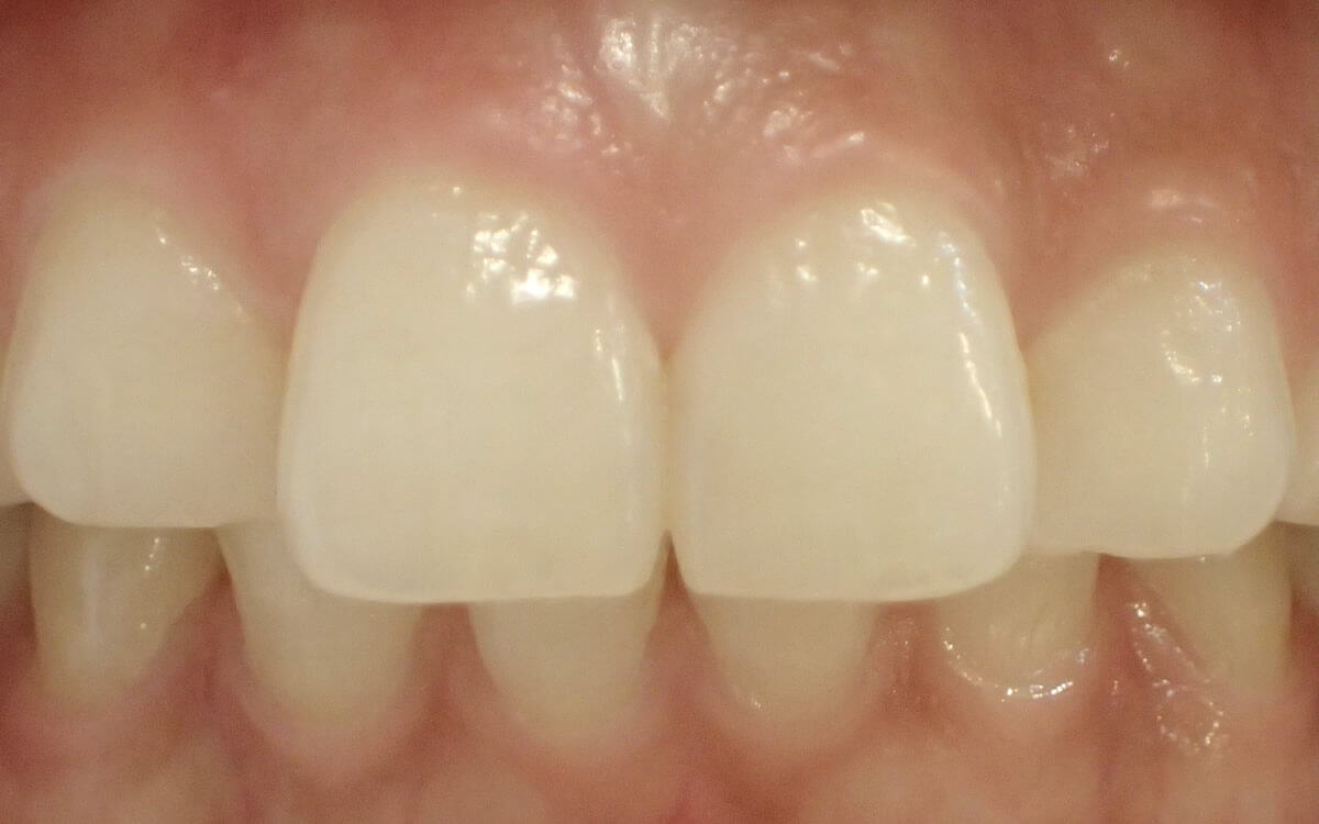 ガミースマイル治療前