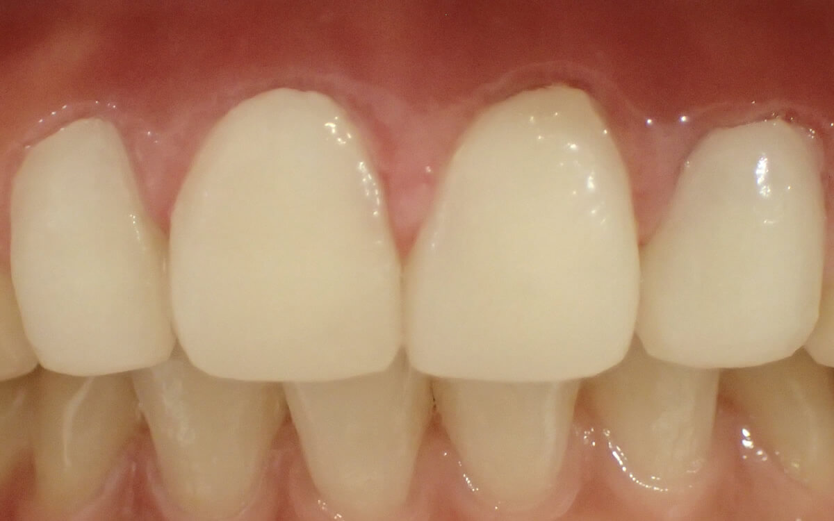 歯肉整形直後（当日）