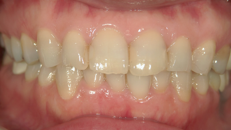 歯を削らずに白くしたい治療前 ケース2
