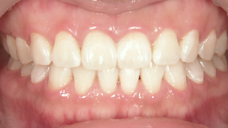 以前のホワイトニングで白くならなかった(治療後) ケース1