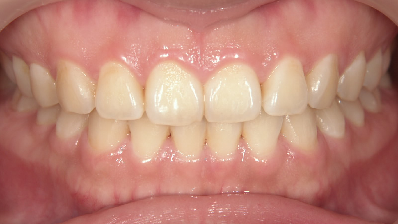 以前のホワイトニングで白くならなかった(治療前) ケース1