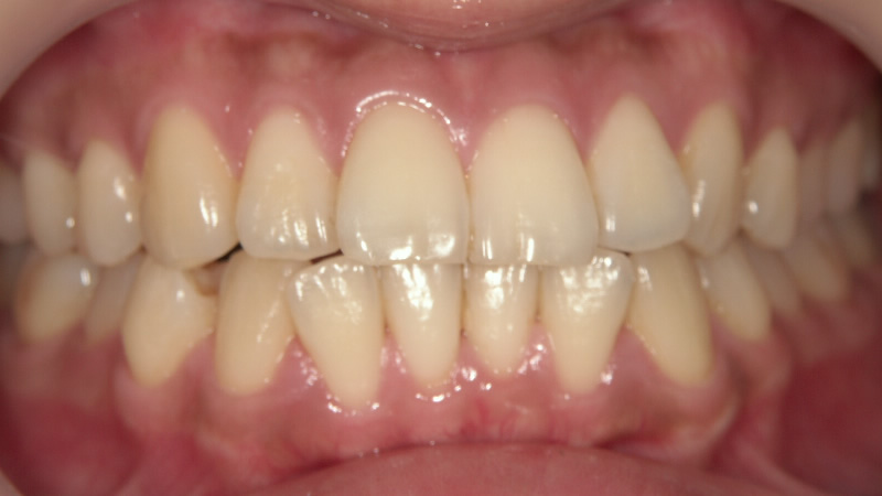 以前のホワイトニングで白くならなかった(治療前) ケース2