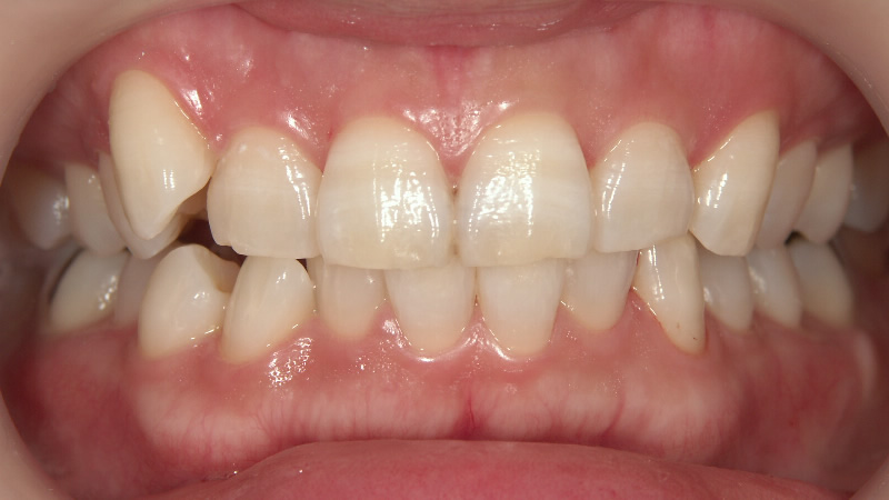 以前のホワイトニングで白くならなかった(治療後) ケース3